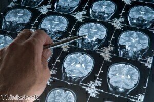 Newly identified metabolic signatures may offer personalised therapy for brain tumours   