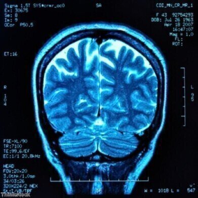Brain tumour treatment results in 'higher than average' survival rates 